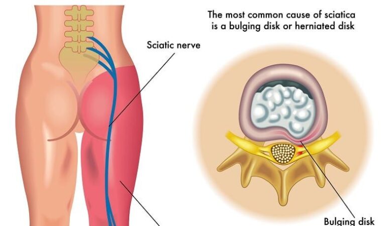 Sciatalgia, un’infiammazione del nervo sciatico che provoca forte dolore nella gamba